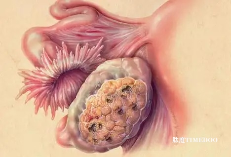 PARP抑制剂维持治疗展现显著疗效，氟唑帕利医保覆盖助力卵巢癌患者诊疗
