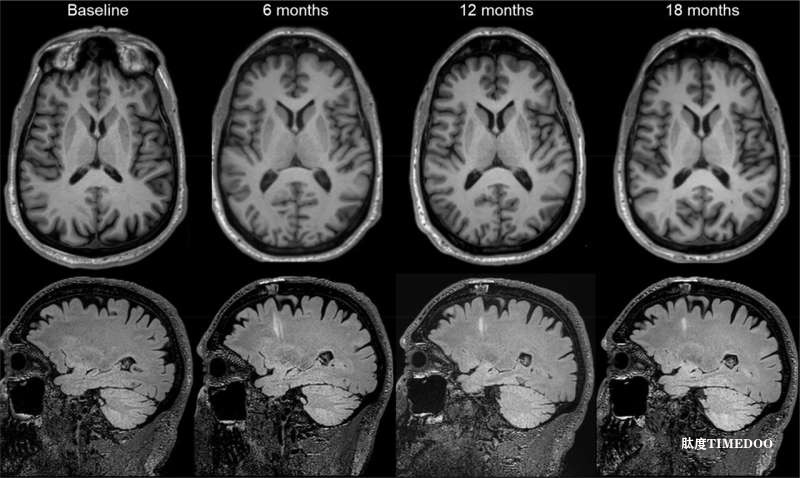 两项独立临床试验证实帕金森病干细胞疗法的安全性-肽度TIMEDOO