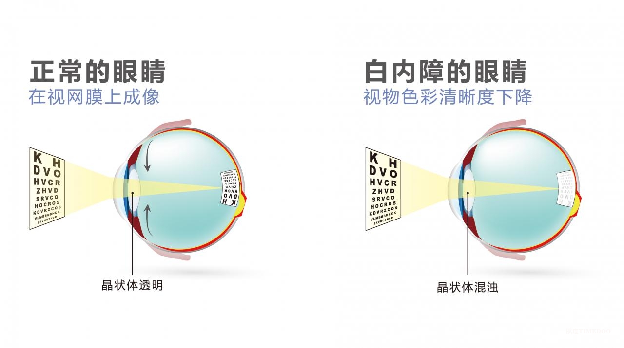 65261751953664_.pic.jpg 做白内障手术,应该如何选择人工晶体?-肽度TIMEDOO