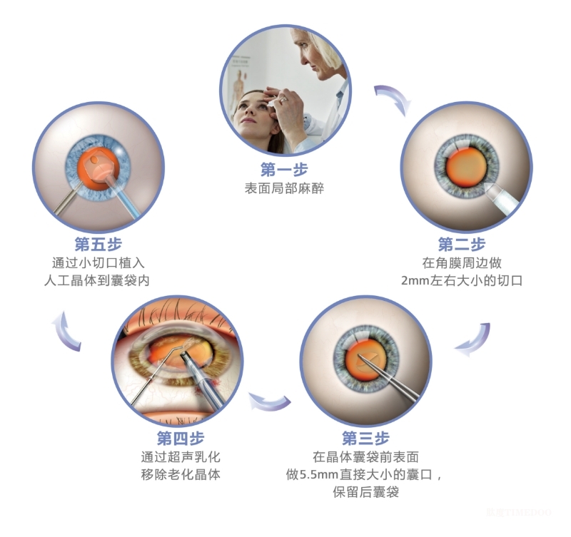 65271751953664_.pic.jpg 做白内障手术,应该如何选择人工晶体?-肽度TIMEDOO