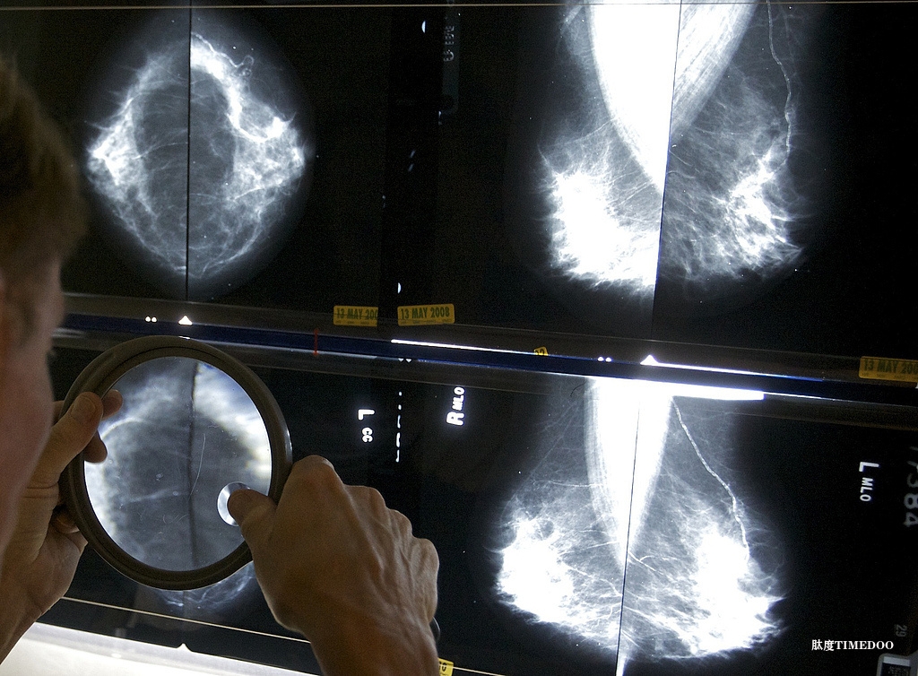 德研究：定期接受乳腺X线筛查可显著降低乳腺癌死亡率