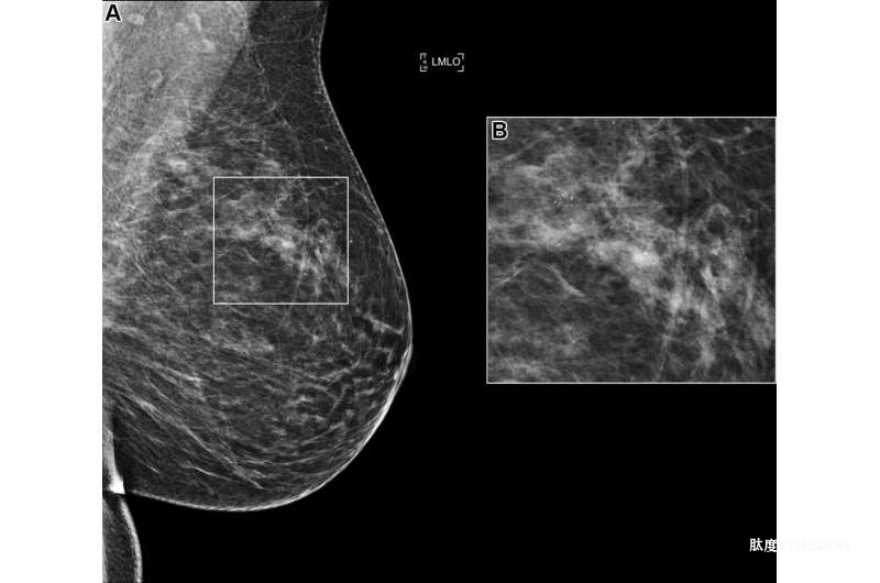 人工智能挑战赛模型能够独立解读乳腺钼靶影像