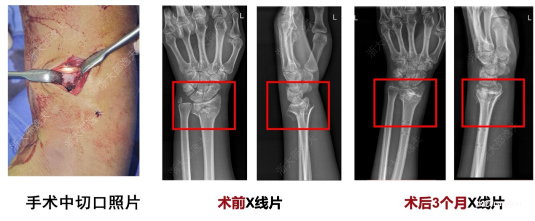 全球首款骨胶水来了——浙大邵逸夫医院自主研发“骨02”实现革命性突破-肽度TIMEDOO