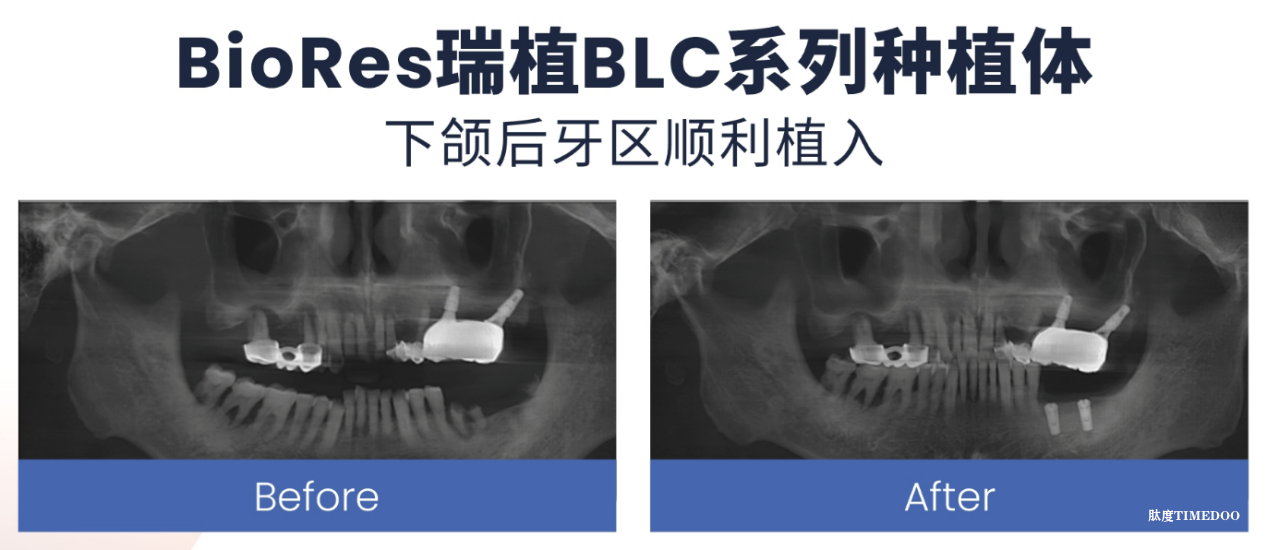 双核驱动,定义未来:BioRes以国际技术与临床认证重塑种植牙金标准-肽度TIMEDOO