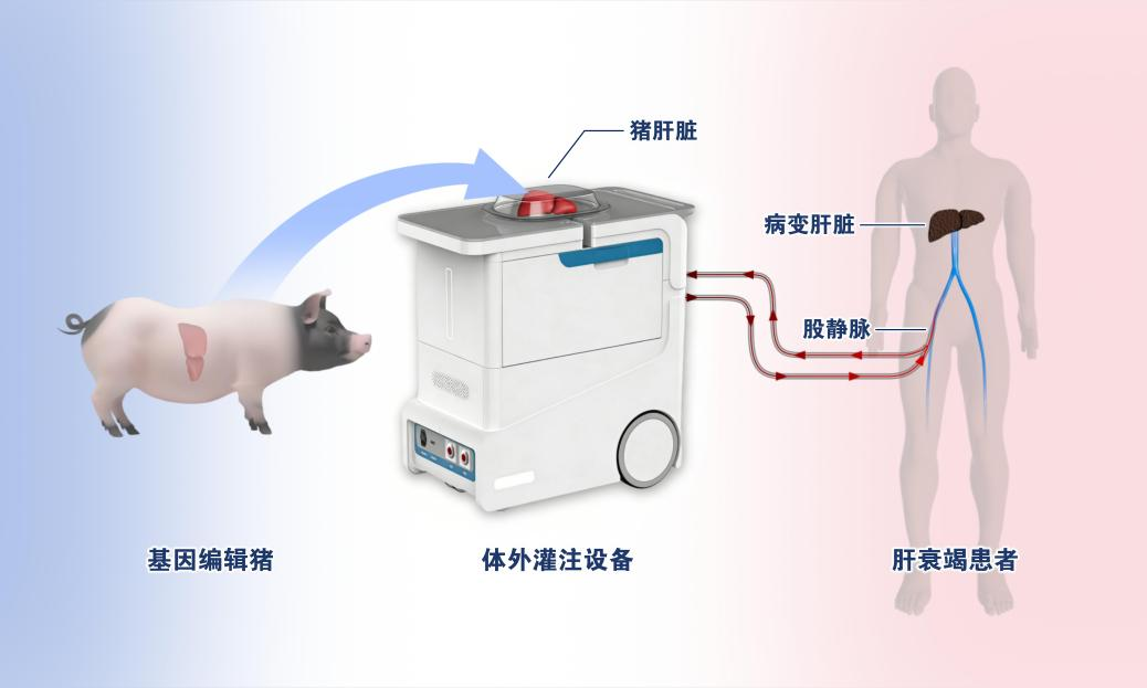 我国成功实施首例基因编辑猪肝体外灌注治疗肝衰竭
