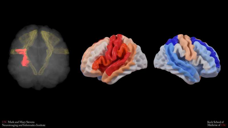 科学家揭示中风后大脑的“补偿性返老还童”现象