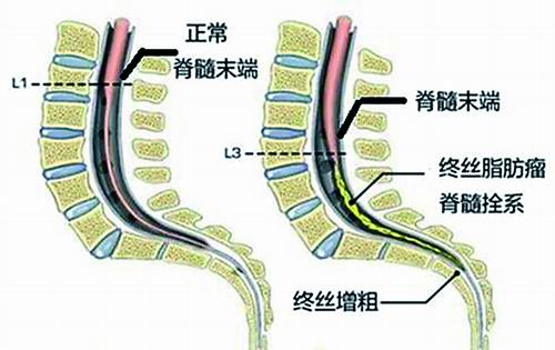 如何科学诊治脊髓拴系？