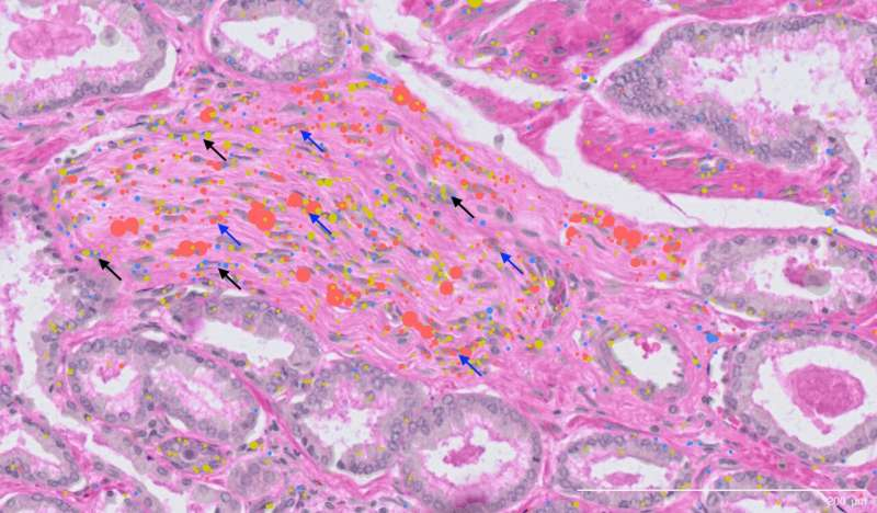Cancer Research|全球最详尽前列腺癌细胞图谱面世，揭示“潜伏”在健康组织中的早期癌变