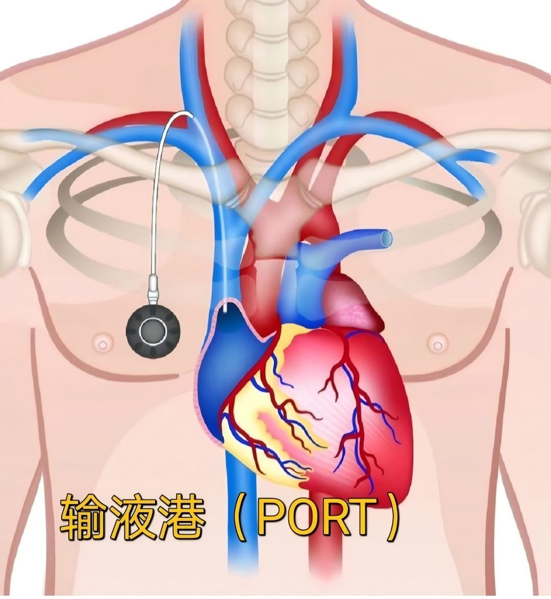 广州泰和肿瘤医院用输液港为化疗儿童搭建“无痛港湾”-肽度TIMEDOO