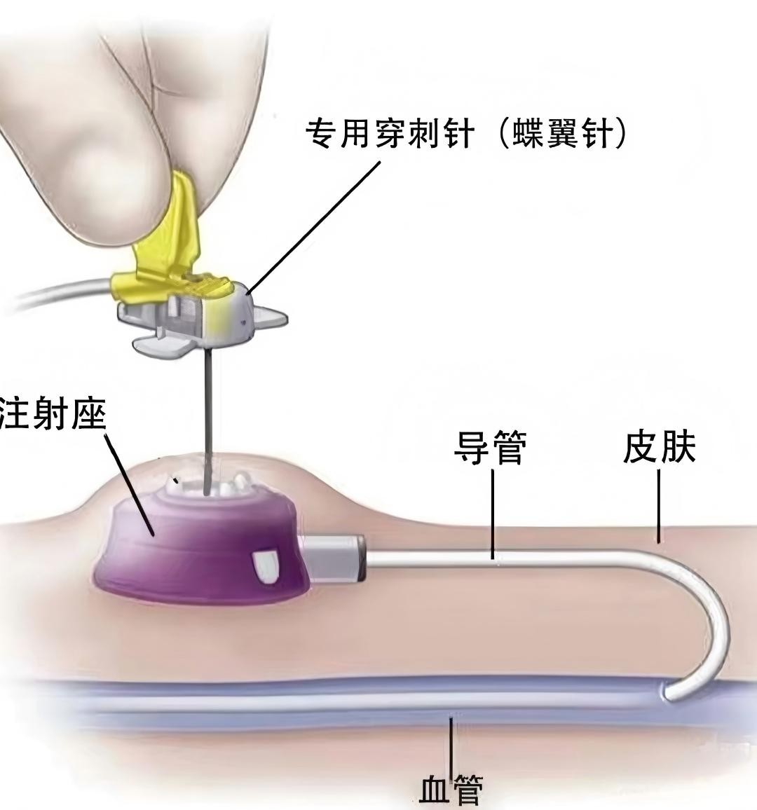 广州泰和肿瘤医院用输液港为化疗儿童搭建“无痛港湾”-肽度TIMEDOO