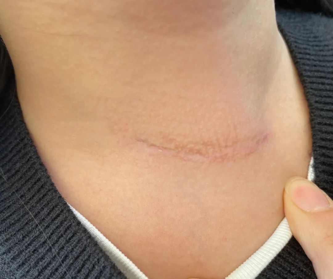研究解析甲状腺乳头状癌肿瘤内异质性
