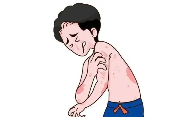 创新泡沫剂型银屑病药物恩适达®（卡泊三醇倍他米松泡沫剂）在华获批，为中国患者带来全新治疗选择