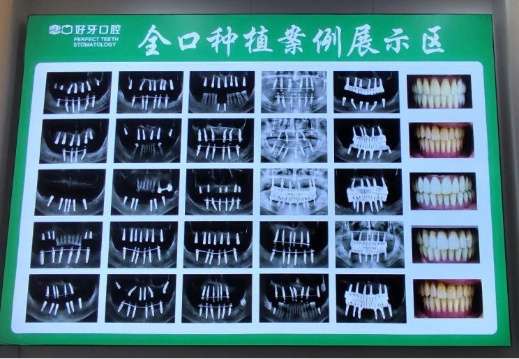 种植牙危害与副作用全解析:北京规范种牙机构——好牙口腔推荐指南-肽度TIMEDOO