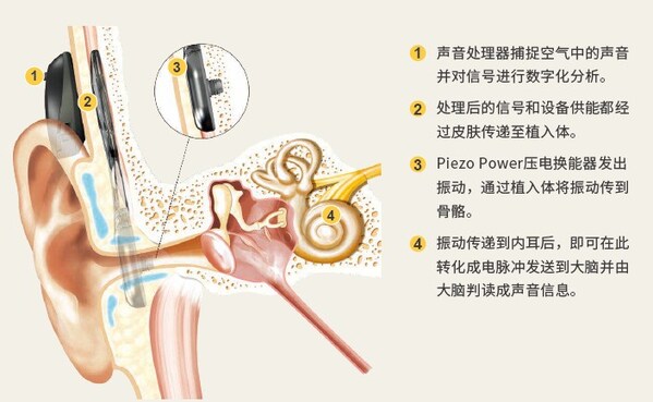 科利耳®澳晰亚™Osia™ 2系统中国大陆上市-肽度TIMEDOO