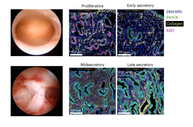 子宫中的免疫细胞 揭示女性生殖健康的新机制